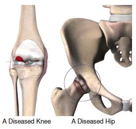 Joint Pain