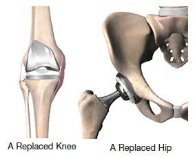 Total Joint Replacement