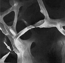 Osteoporotic Bone