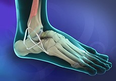 Ankle Ligament Reconstruction