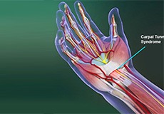 Carpal Tunnel Syndrome