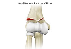 Distal Humerus Fractures of the Elbow