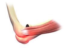 Elbow Sprain