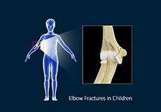 Forearm Fractures in Children