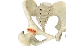 Hip Arthritis