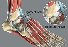 Ligament Tears in the Foot