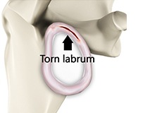 Labral Tear