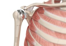 Total Shoulder Joint Replacement