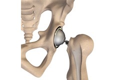 Total Hip Joint Replacement
